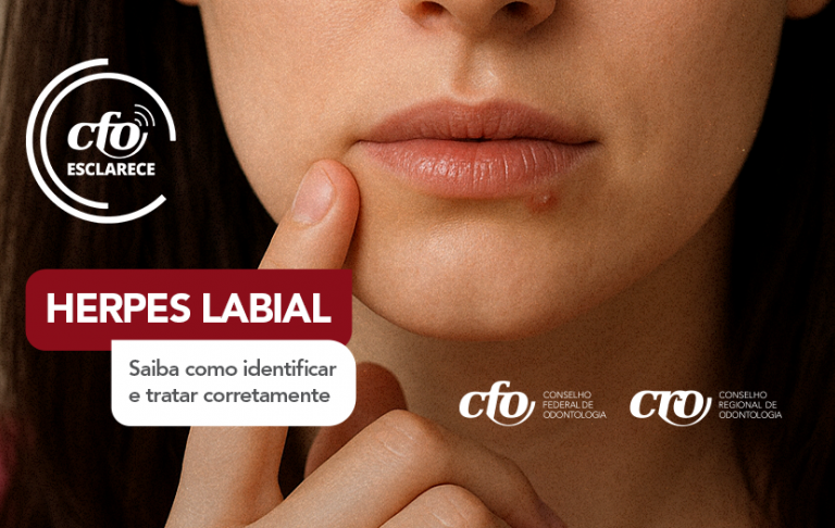 CFO Esclarece: Entenda o que é o herpes labial e o papel do cirurgião-dentista no tratamento das infecções